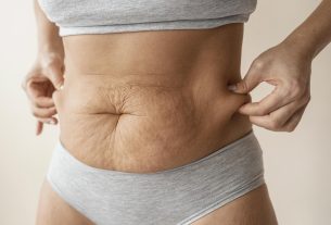 Mulher mostrando pele flácida na região abdominal, segurando as laterais da barriga com as mãos.