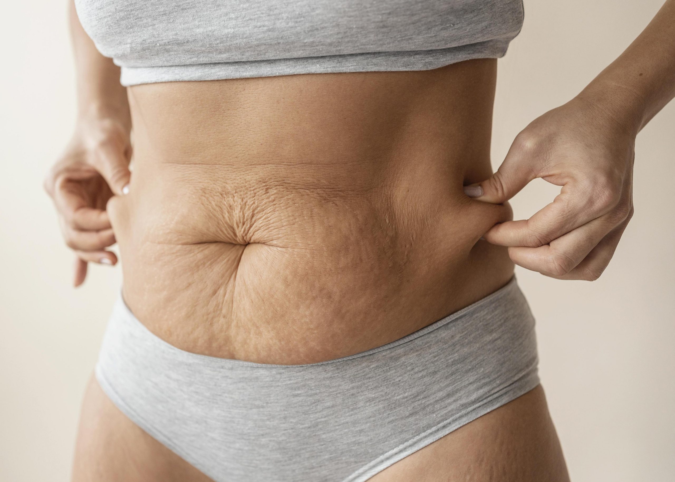 Mulher mostrando pele flácida na região abdominal, segurando as laterais da barriga com as mãos.
