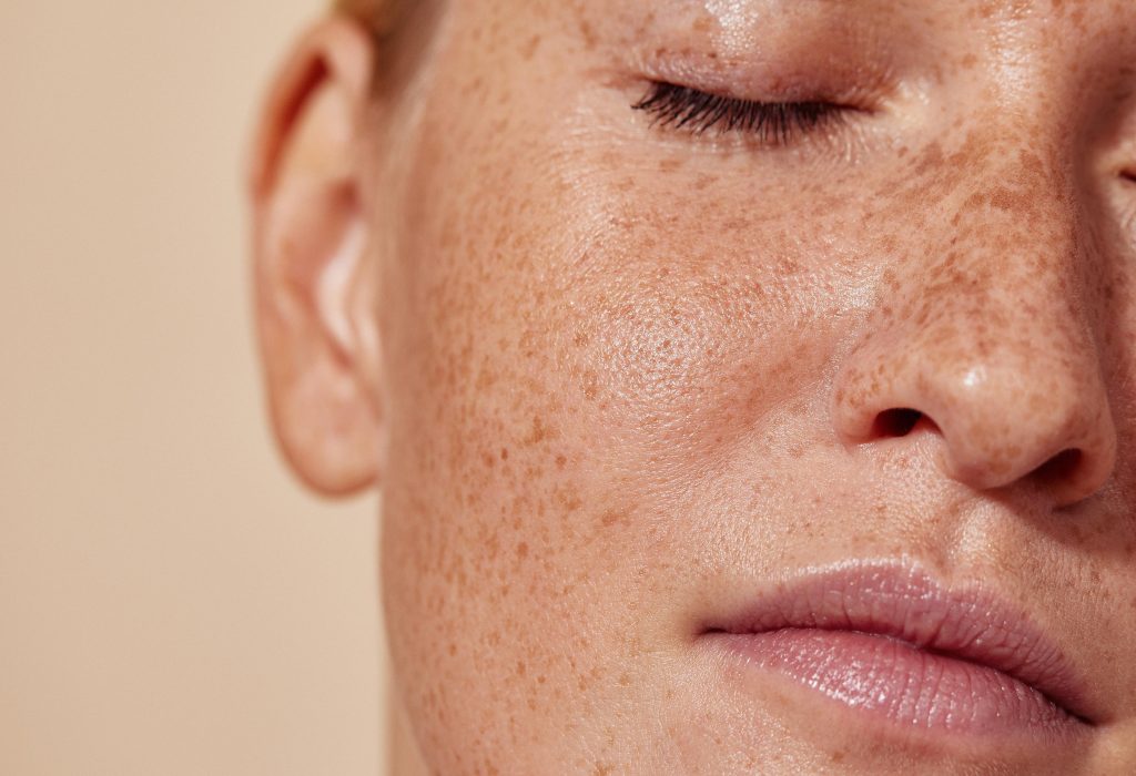Melasma no rosto feminino, destacando manchas escuras na pele e a importância de cuidados para prevenção e tratamento.