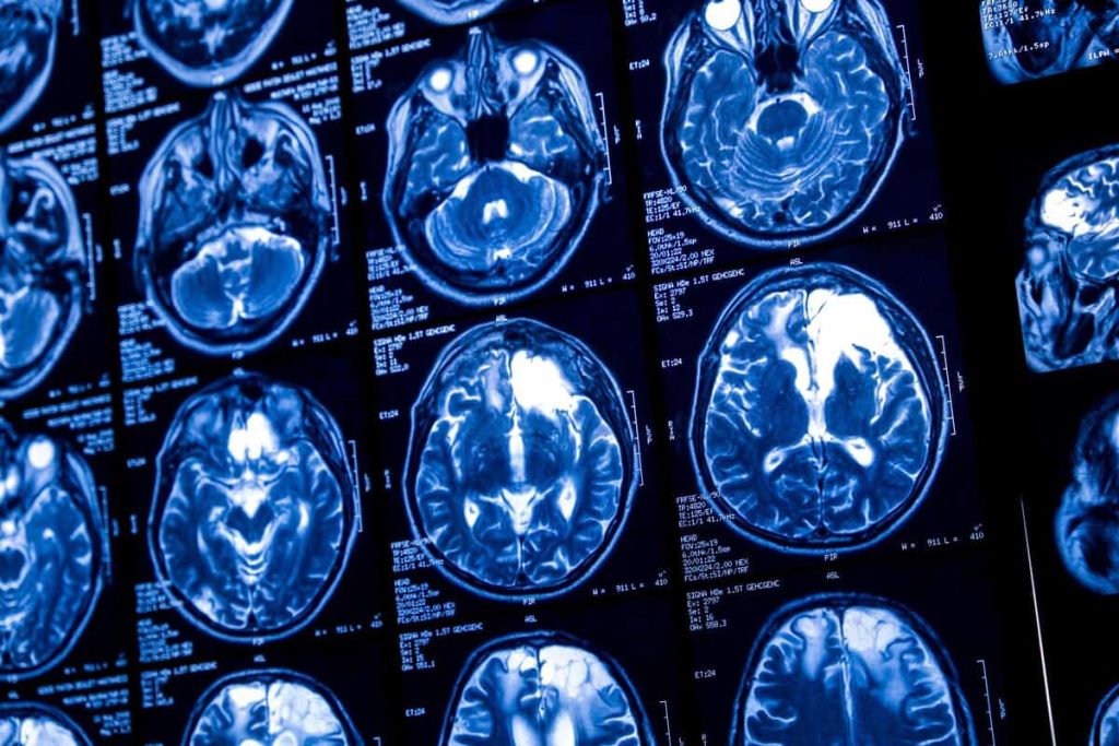 Exames de ressonância magnética do cérebro mostram como a musicoterapia ativa áreas ligadas às emoções e à memória.