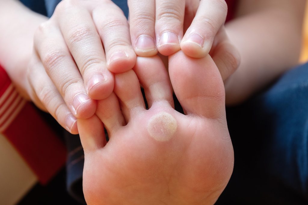 Verruga plantar no pé causada pelo HPV, resultado da invasão microbiana nas células da pele.