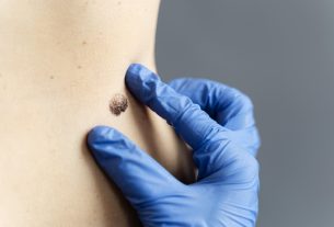 Profissional de saúde examina verruga na pele para diagnóstico e definição do tratamento adequado